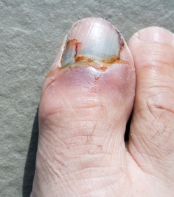Blog Mark's broken toe